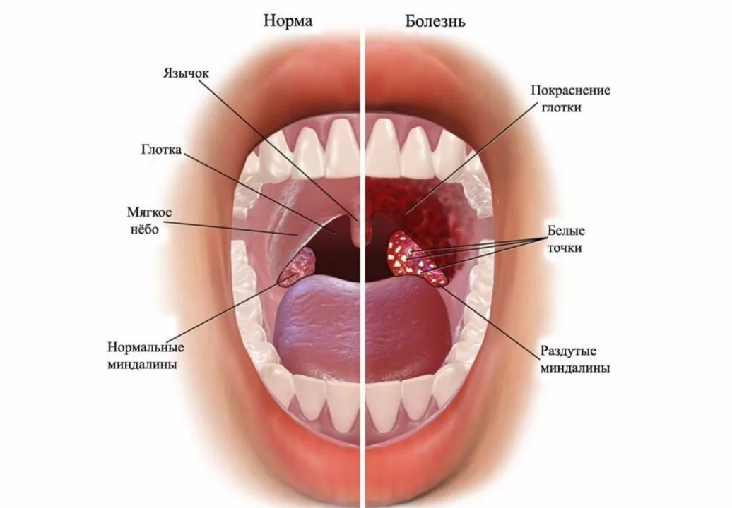 Acitretina y Mucositis: Manejo de Problemas en la Boca y Garganta durante el Tratamiento